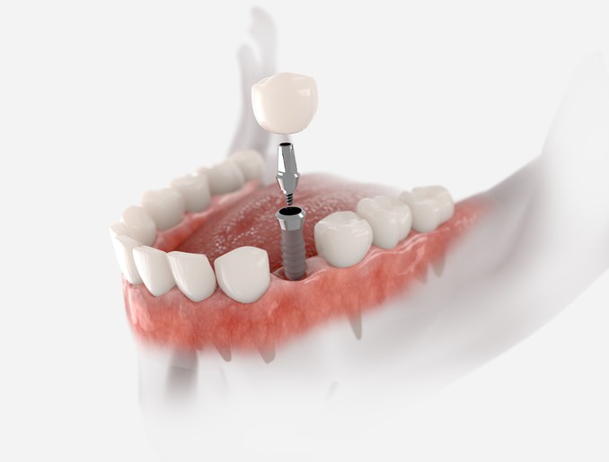 What Is A Dental Implant? What Is A Dental Implant?