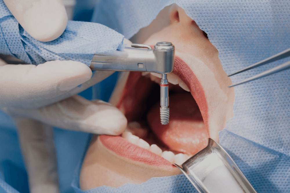 Implant Placement Implant Placement