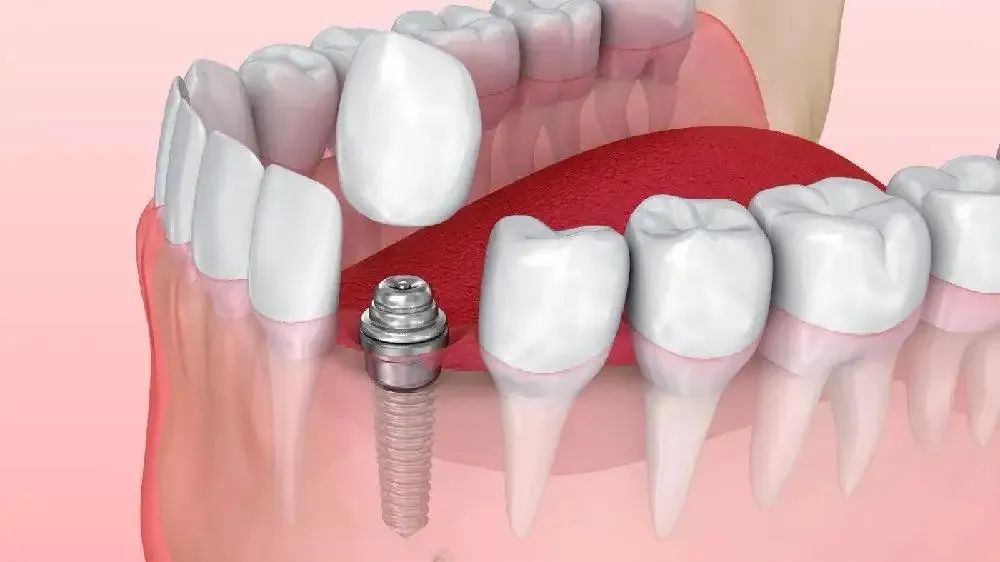 Safety Of Dental Implants Safety Of Dental Implants